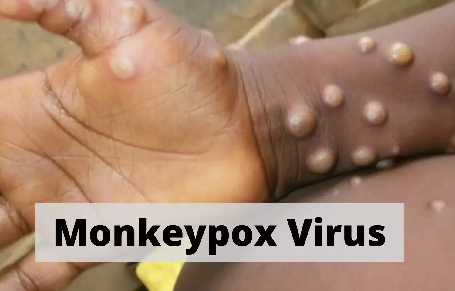 monkeypox-virus