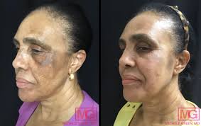 SKIN BLEACHING